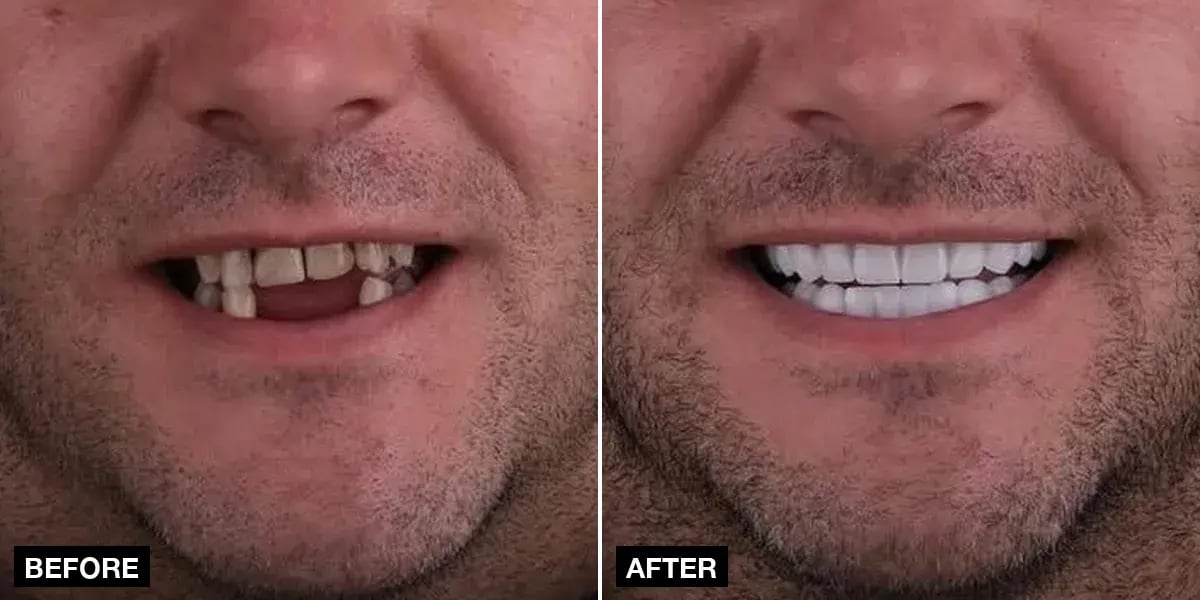 Before and after: 12 implants + 24 zirconia crowns, Klinik No.1, Istanbul