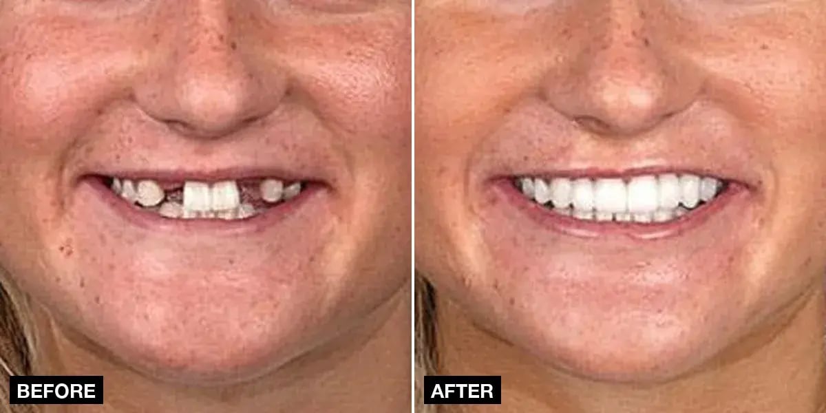 Before and after: 5 implants + 24 zirconia crowns, Klinik No.1, Istanbul