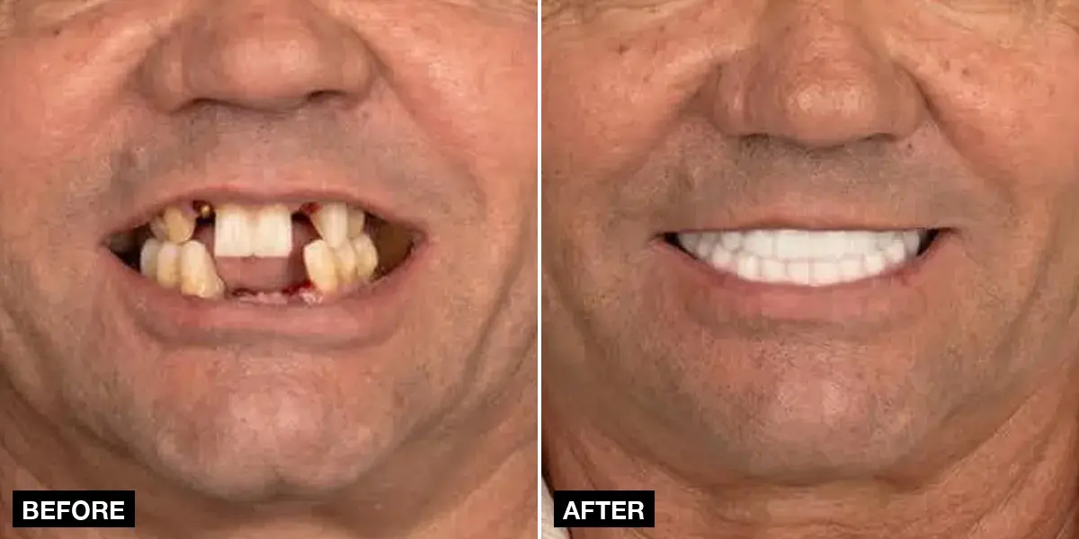 Before and after: 12 implants + 24 zirconia crowns, Klinik No.1, Istanbul