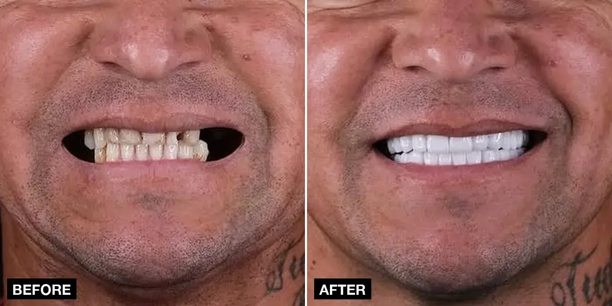 Before and after: 8 implants + 28 zirconia crowns, Klinik No.1, Istanbul
