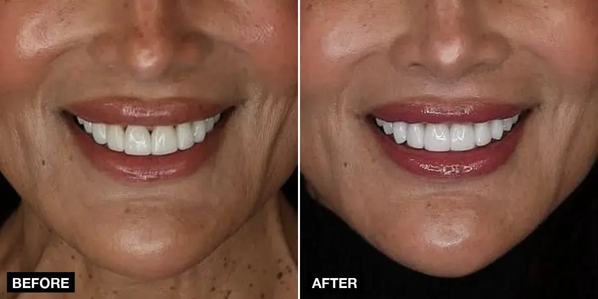 Before and after: 20 laminate veneers, Klinik No.1, Istanbul