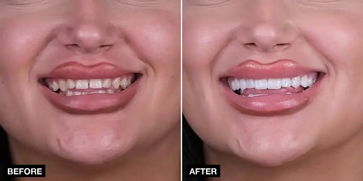 Before and after: 20 laminate veneers, Klinik No.1, Istanbul