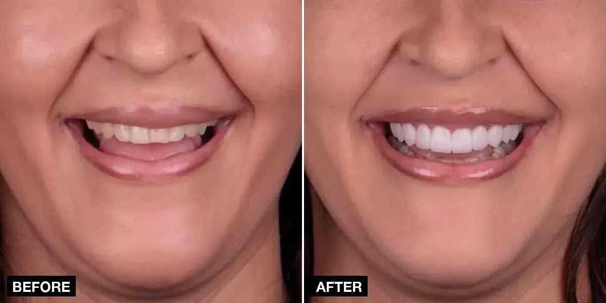 Before and after: 20 laminate veneers, Klinik No.1, Istanbul