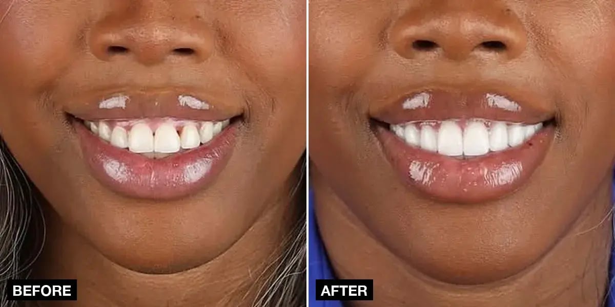 Before and after: 20 laminate veneers, Klinik No.1, Istanbul