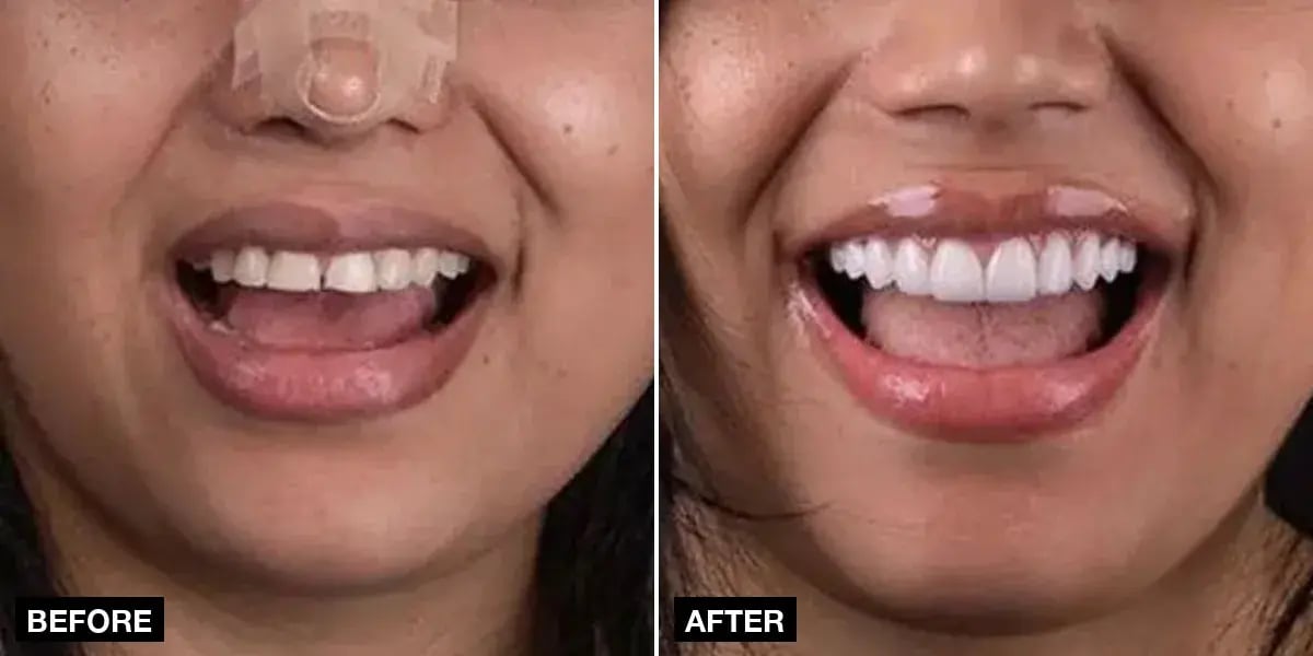 Before and after: 20 e.max veneers, Klinik No.1, Istanbul