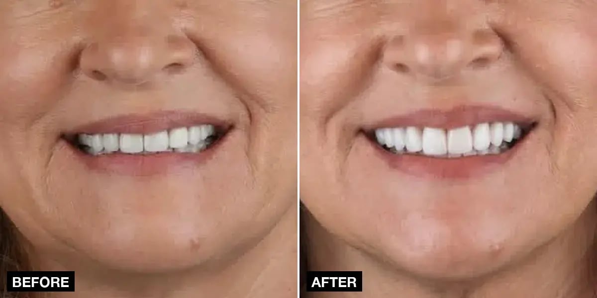 Before and after: Hollywood smile: 20 e.max veneers, 4 implants and 4 zirconia crowns, Klinik No.1, Istanbul