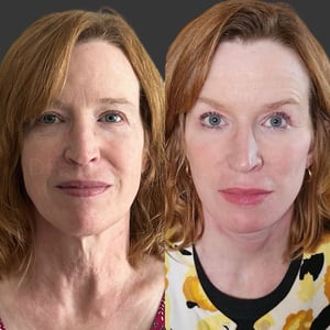 Before and after, Facelift by Dr. Mehmet Cömert
