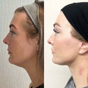 Before and after, Facelift by Dr. Mehmet Cömert
