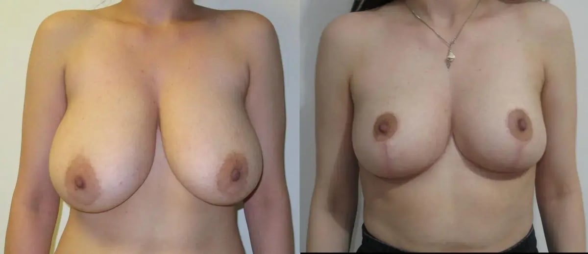 Breast reduction with lift - front view, before (left) and after (right), by Dr. Reşat Aktaş