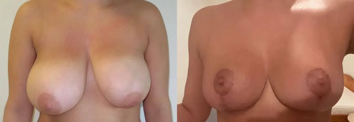 Breast reduction with lift - front view, before (left) and after (right), by Dr. Reşat Aktaş