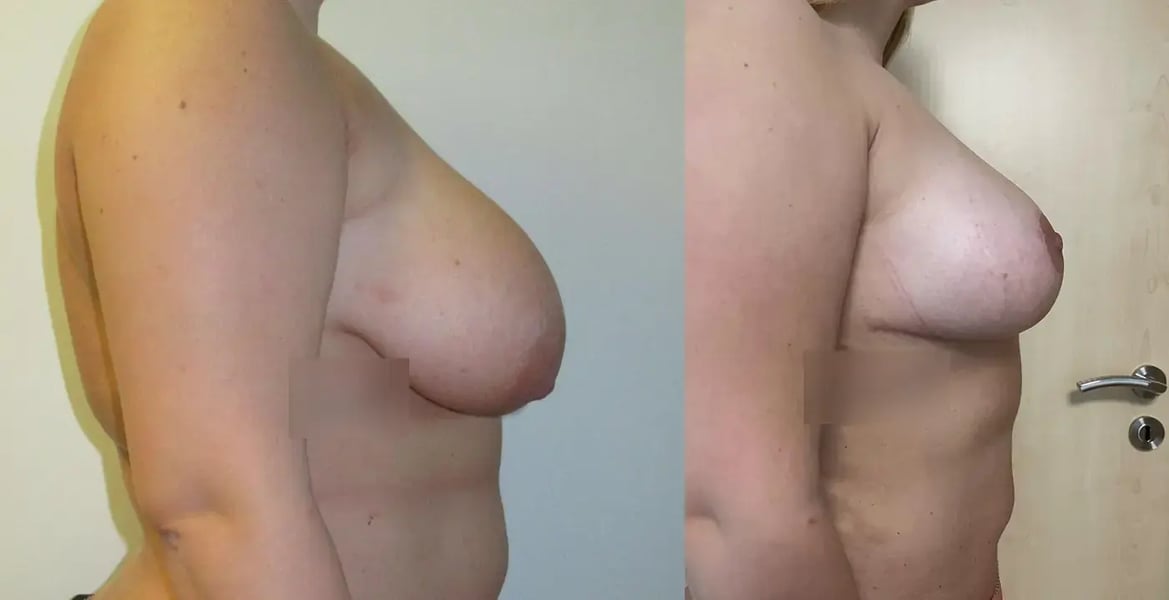 Breast reduction with lift - side view, before (left) and after (right), by Dr. Reşat Aktaş