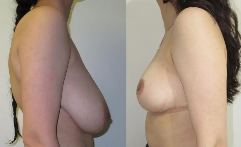 Breast reduction with lift - side view, before (left) and after (right), by Dr. Reşat Aktaş
