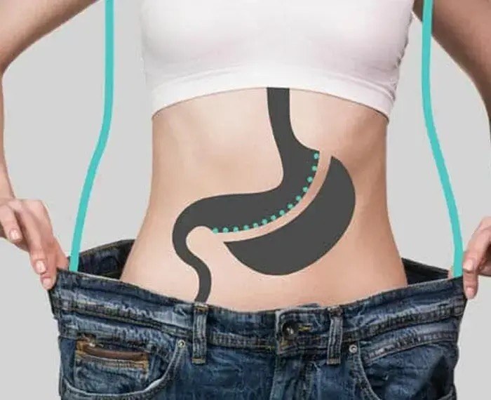 Gastric sleeve: about 75-80% of the stomach is removed, leaving a narrow sleeve