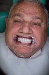 Full-arch: implants + fixed hybrid bridges, both jaws