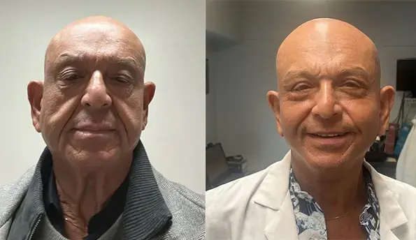 Mazhar, facelift with Dr. Serhat Tuncer