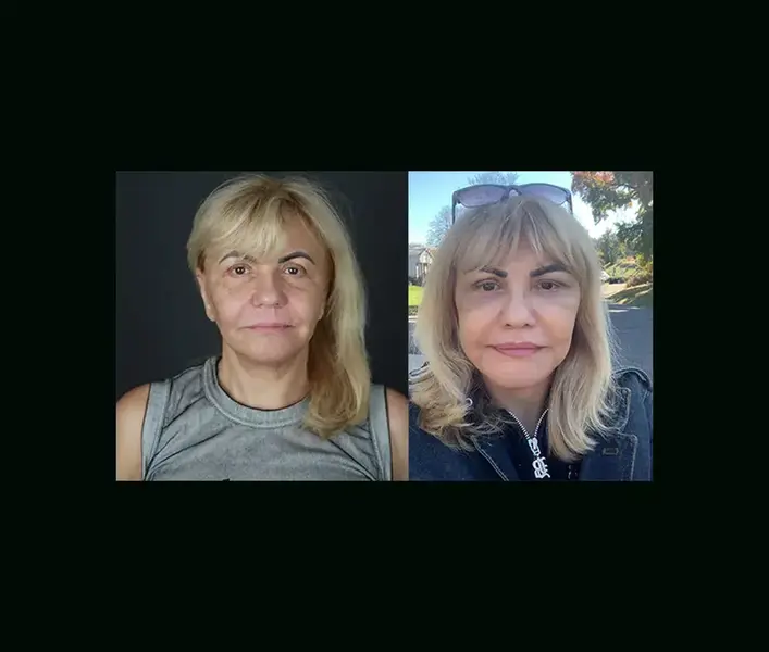 Yanna, facelift with Dr. Mehmet Cömert