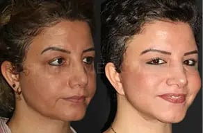 mehmet-comert-md-face-lift-before-and-after-7