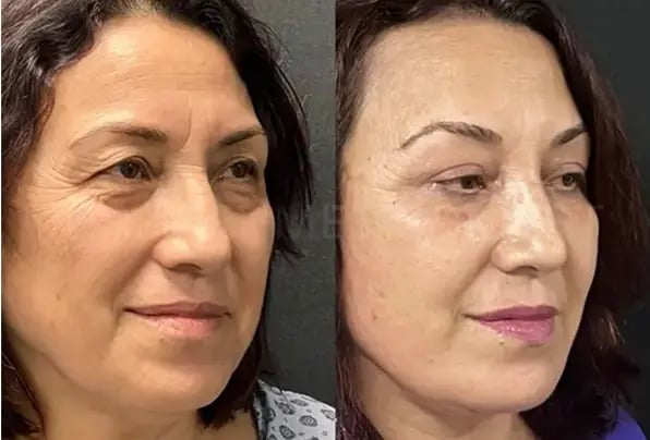 mehmet-comert-md-facelift-before-and-after-26-1-1