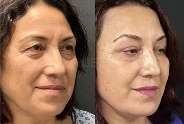 Lo*** after face lift