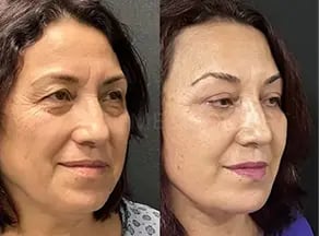 mehmet-comert-md-facelift-before-and-after-26