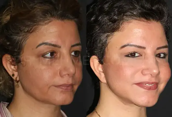 Al***, facelift with Dr. Mehmet Cömert