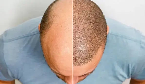 men-hair-transplant