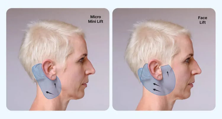 mini-facelift-and-facelift-difference