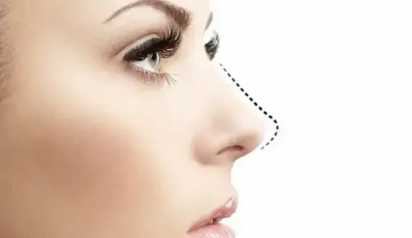 nasal-rhinoplasty