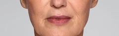 What are the Nasolabial Folds?