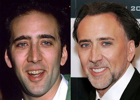 nicolas-cage-smile-design