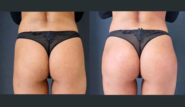 non-surgical-butt-lift-before-after