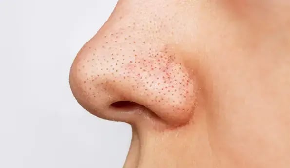 nose-blackheads