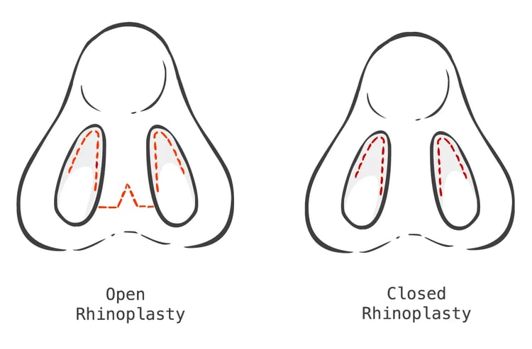 open-rhinoplasty