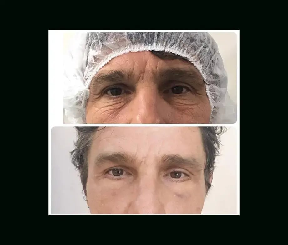ozgul-ugurtay-md-eyelid-before-after-5