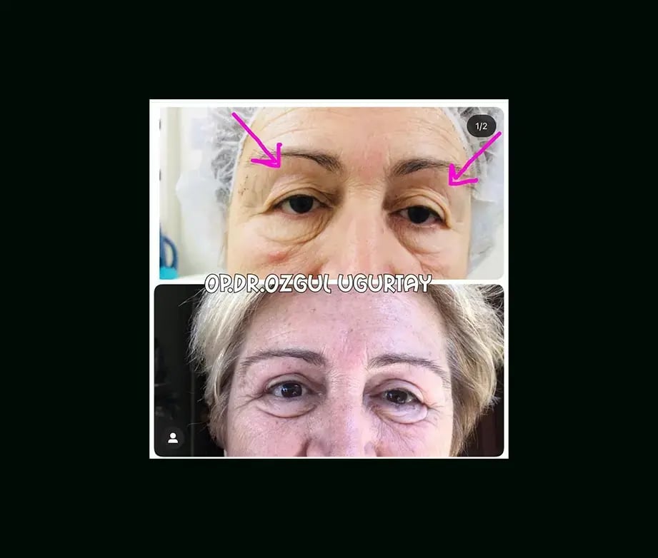 ozgul-ugurtay-md-eyelid-before-after-6