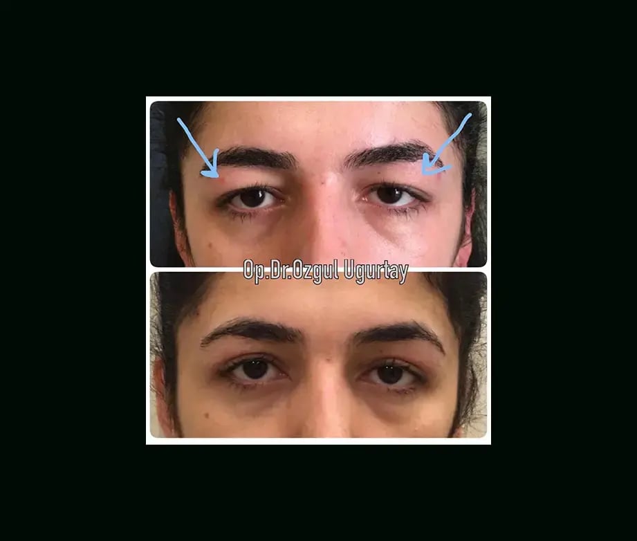 ozgul-ugurtay-md-eyelid-before-after-7