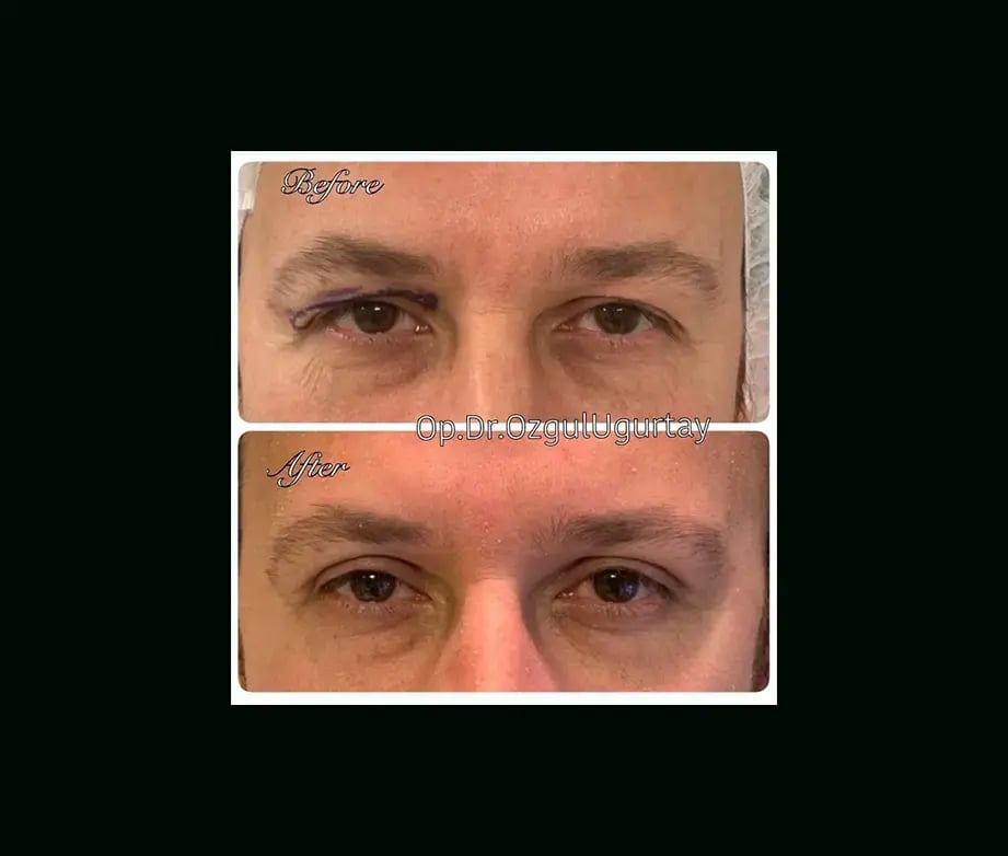 ozgul-ugurtay-md-eyelid-before-after-8