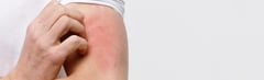 What is Pruritus (Itchy Skin)?