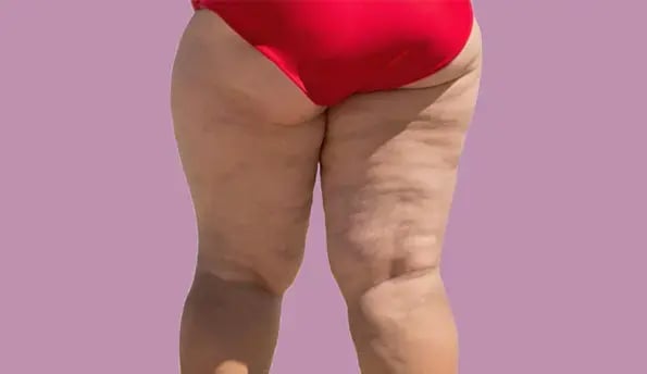 recovery-after-lipedema