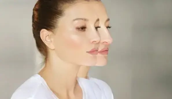 rhinoplasty-before-after