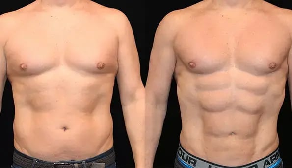 six-pack-surgery-before-after