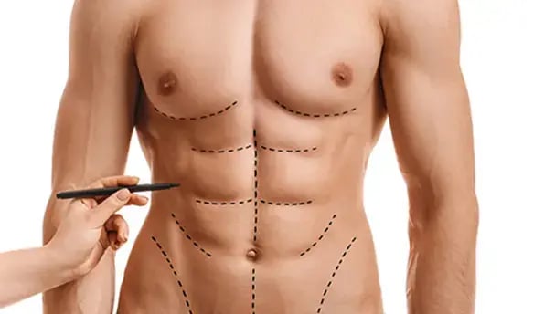 six-pack-surgery