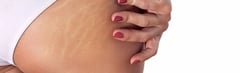 What are Stretch Marks?