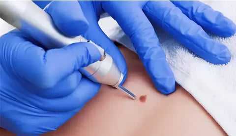 Skin Tag Treatment