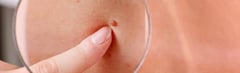 What are Skin Tags?