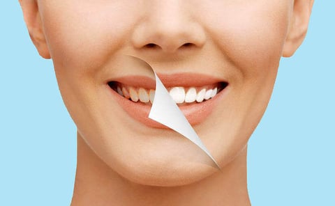 Smile Makeover