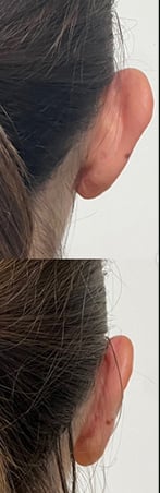 tayfun-demirel-md-ear-surgery-before-after-1