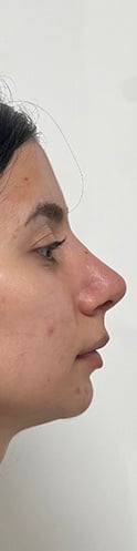 tayfun-demirel-md-rhinoplasty-before-after-10