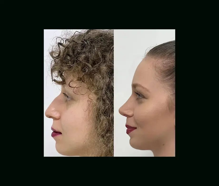 tayfun-demirel-md-rhinoplasty-before-after-36-1