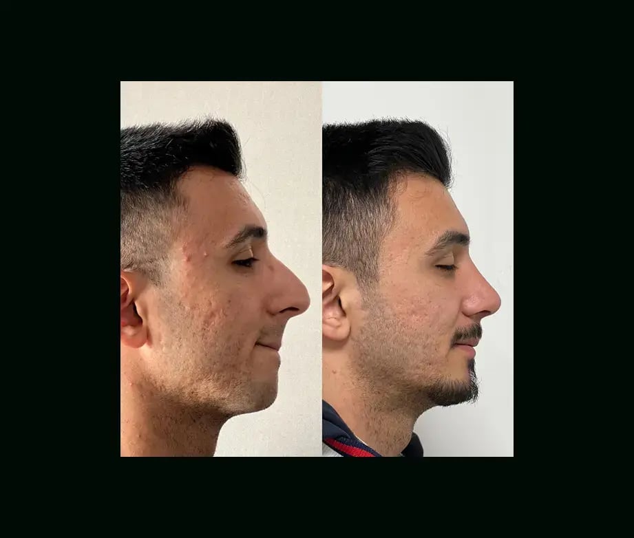 tayfun-demirel-md-rhinoplasty-before-after-42-1